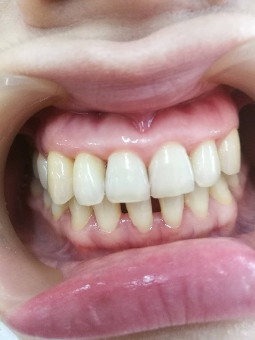 牙周病矫正1.jpg